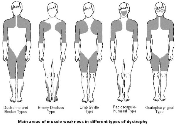 Muscular Dystrophy Physioline 1941