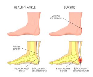 Retrocalcaneal Bursitis Treatment | Retrocalcaneal Bursitis Specialist ...